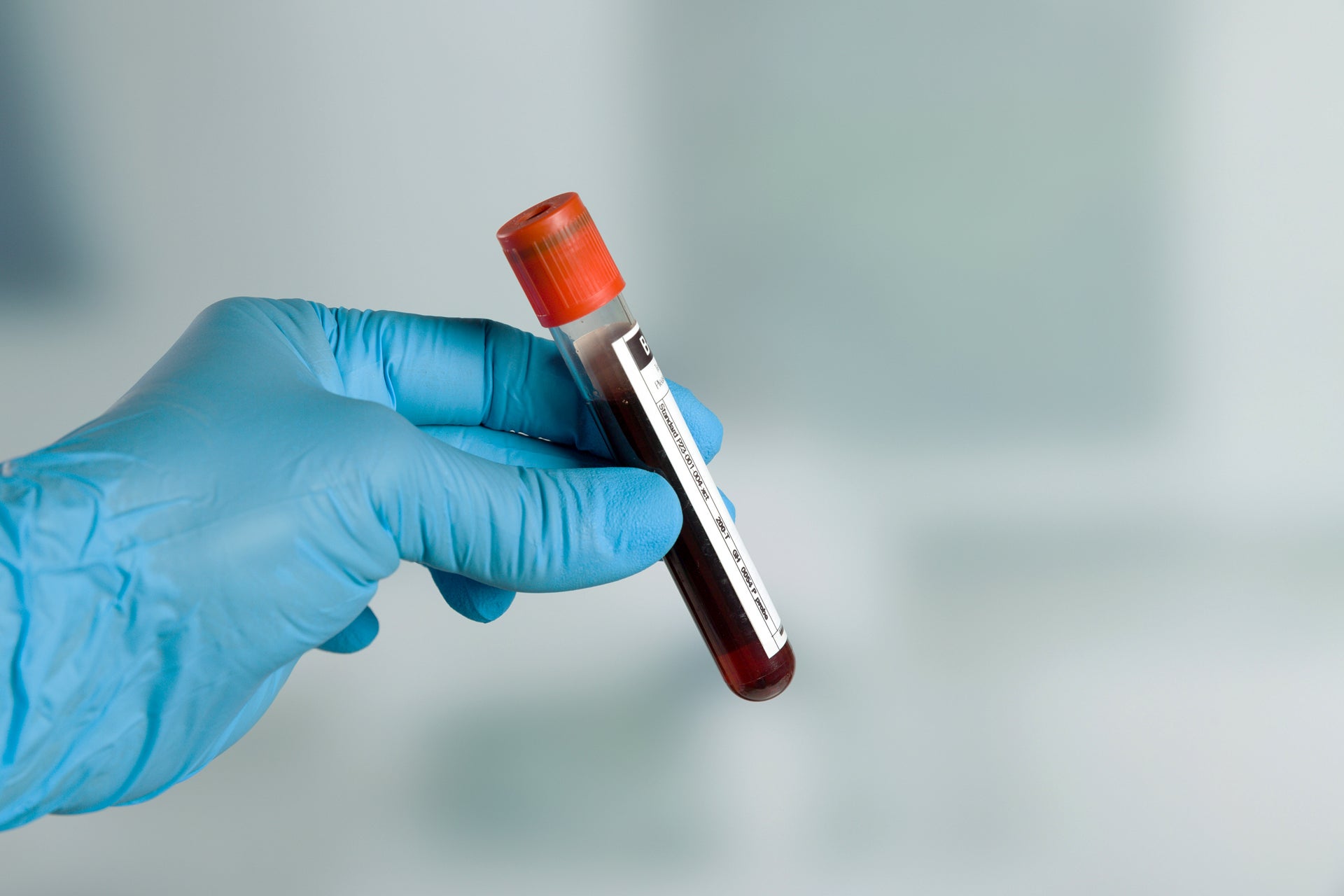 Eine behandschuhte Hand hält ein mit Blut gefülltes Probenröhrchen mit rotem Deckel. Der Hintergrund ist unscharf gehalten.
