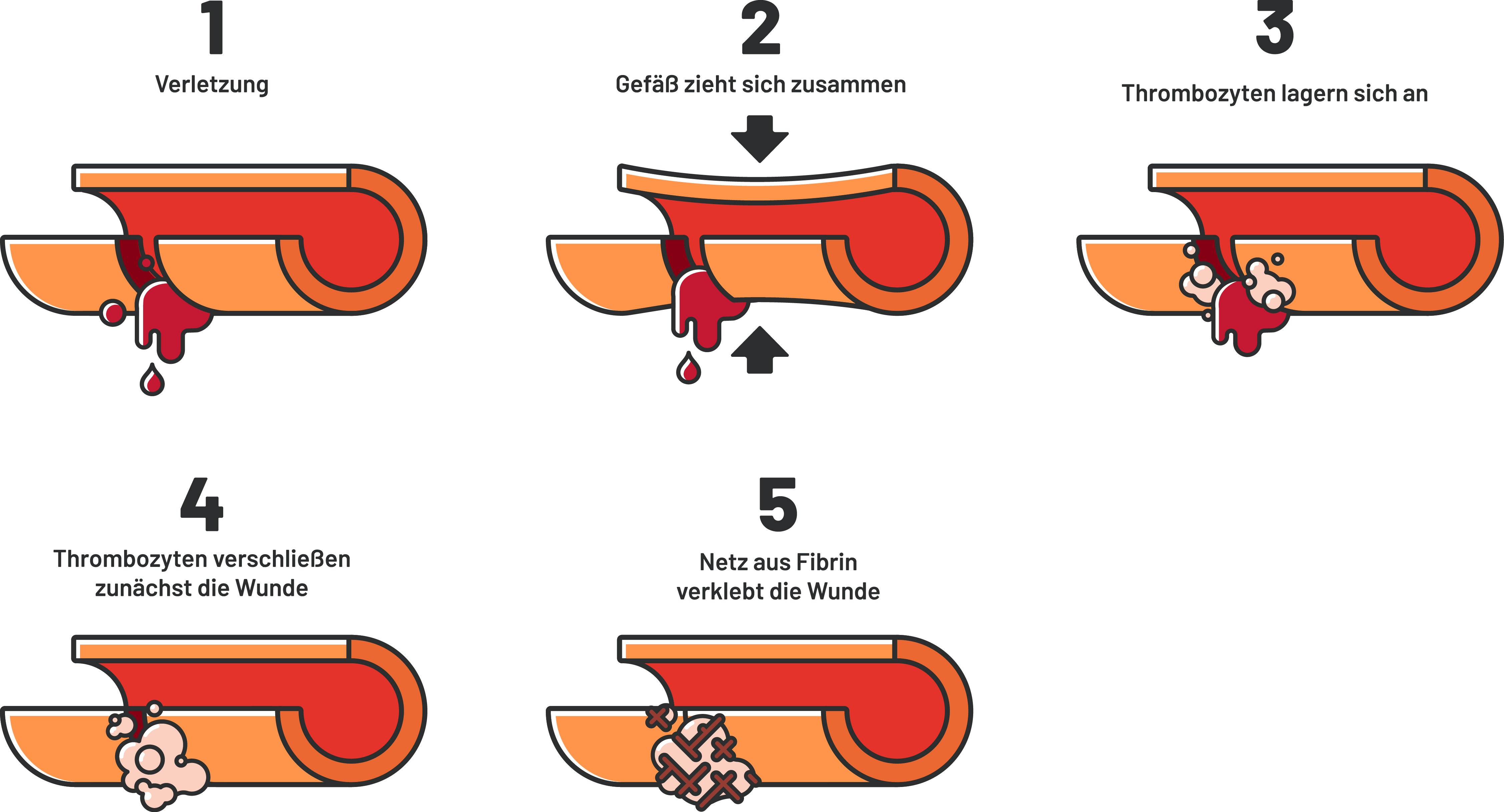 Zu sehen ist eine schematische Darstellung der Blutgerinnung: Nach einer Verletzung zieht sich das Blutgefäß zusammen, Thrombozyten lagern sich an der Wunde an und verschließen sie zunächst. 