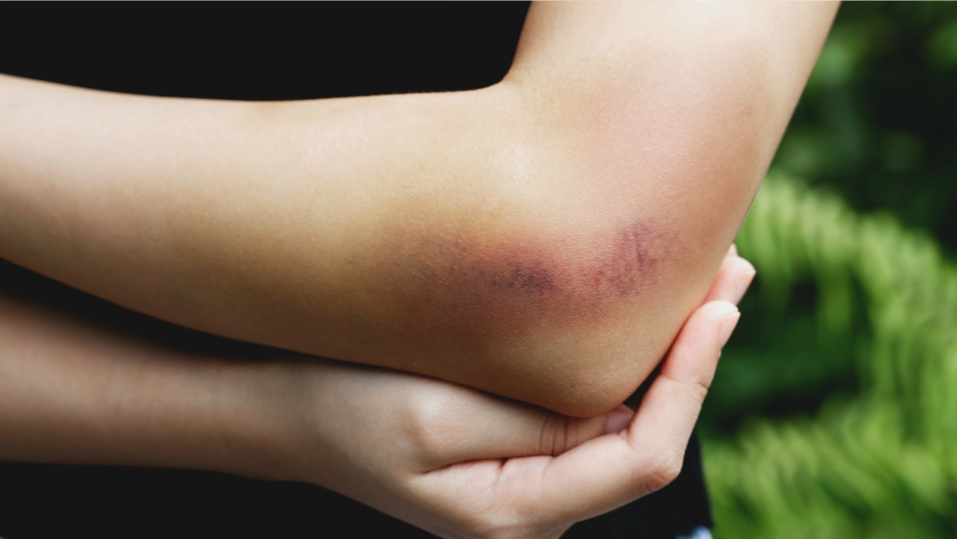 Ein gebeugter Arm mit einem deutlich sichtbaren blauen Fleck (Hämatom) im Bereich des Ellenbogens. Die andere Hand hält vorsichtig den Ellenbogen, was auf Schmerzen oder Beschwerden hinweisen könnte. Im Hintergrund ist etwas Grün zu erkennen, vermutlich im Freien.