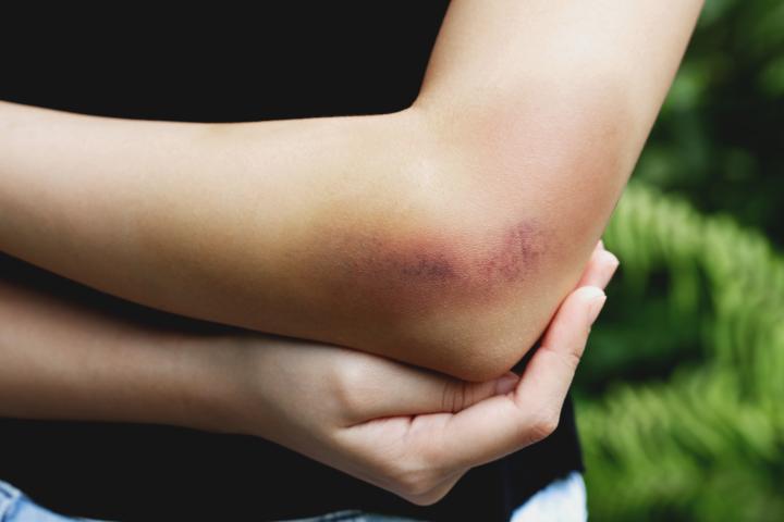 Ein gebeugter Arm mit einem deutlich sichtbaren blauen Fleck (Hämatom) im Bereich des Ellenbogens. Die andere Hand hält vorsichtig den Ellenbogen, was auf Schmerzen oder Beschwerden hinweisen könnte. Im Hintergrund ist etwas Grün zu erkennen, vermutlich im Freien.